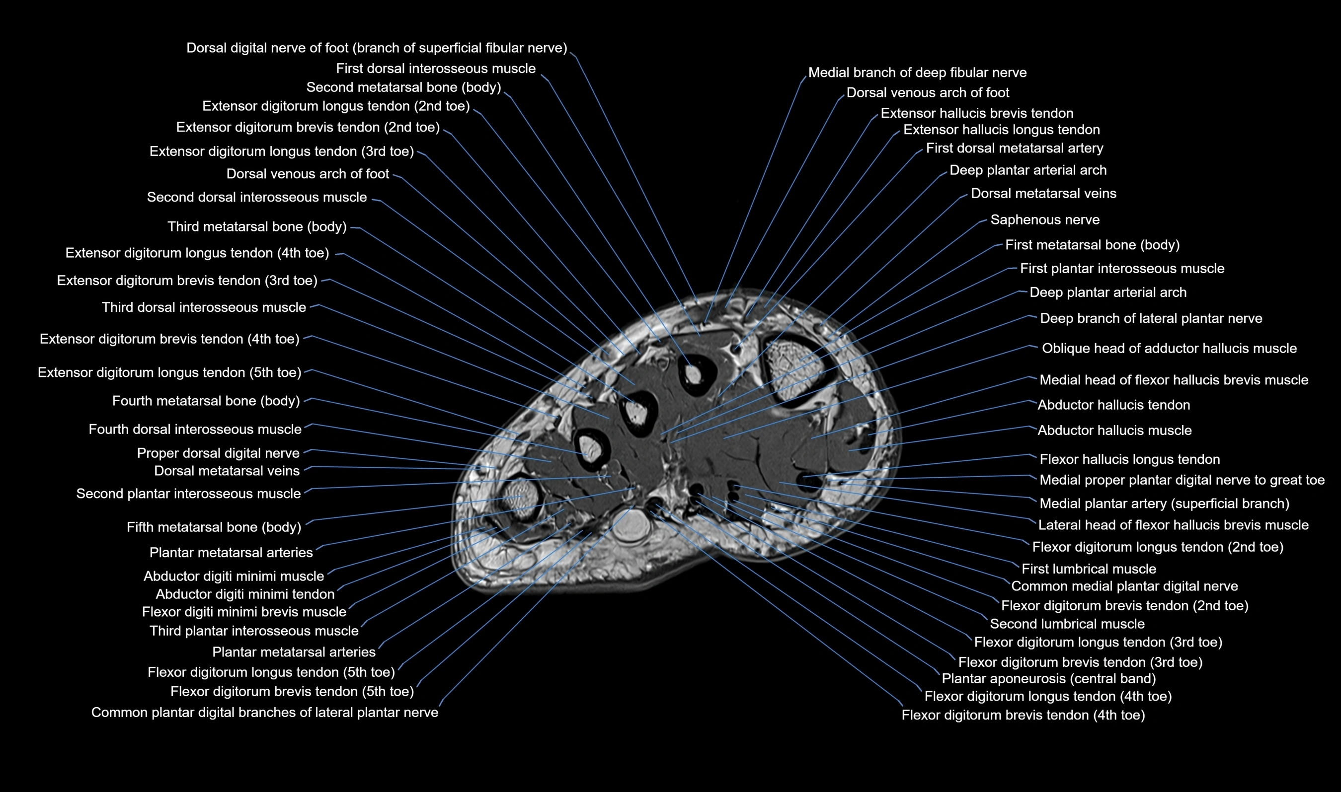 MRI mid foot axial cross sectional anatomy 3T  radiology  image-img-00001-00001.webp